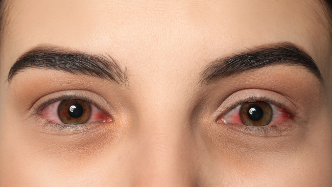 Konjuktivitis